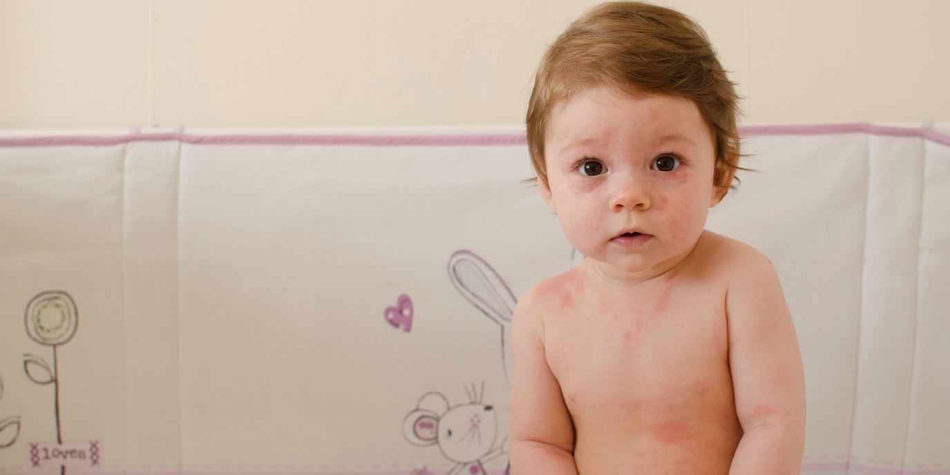Les maladies éruptives de l’enfant | Citadelle